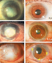 Tratamento com células-tronco recupera olhos danificados e permite que pacientes voltem a exergar. AP / New England Journal of Medicine
